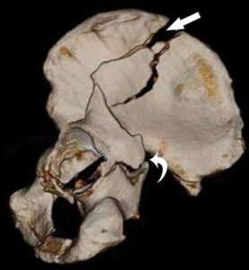 كسور الحُقّ: التشخيص والعلاج وفق أحدث المفاهيم الطبية