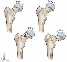 Clinical Practice Guideline for Physicians: Management of Femoral Neck Fractures