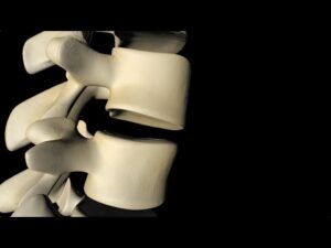 Spine Surgery جراحة العمود الفقري