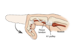 إصبع الزناد (Trigger Finger) – الأسباب، الأعراض، والعلاج