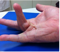 مرض دوبويتران (انكماش دوبويتران) Dupuytren’s Disease – الأسباب، الأعراض، والعلاج