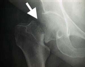 a00392f04 fracture xray min