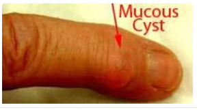 كيسة المعصم واليد (Ganglion Cyst) 3 image 1