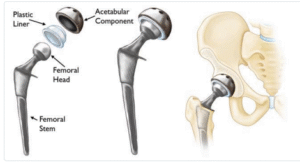 استبدال مفصل الورك الكامل (Total Hip Replacement)