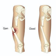 Principles of management of open fractures