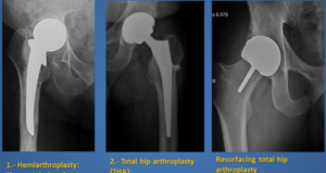 الفرق بين الاستبدال الكلي والجزئي للمفاصل