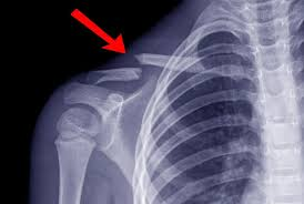 الدليل الحديث لعلاج كسور الترقوة الصادر عن الأكاديمية الأمريكية لجراحة العظام (AAOS)