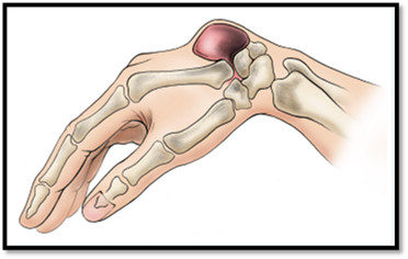 كيسة المعصم واليد (Ganglion Cyst) 2 image