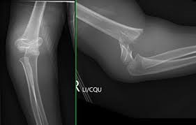 الدليل السريري لعلاج كسور فوق اللقميّة لعظم العضد عند الأطفال