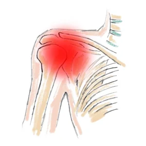 impingement syndrom schulter symptome