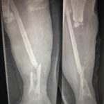 صور ساق يمنى يظهر الضياع العظمي