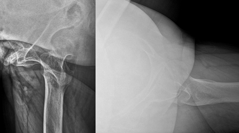 تدبير خلل التنسج الوركي الشديد DDH لدى سيدة بعمر متوسط Management of a hip dysplasia in a middle-aged woman 2 image 82