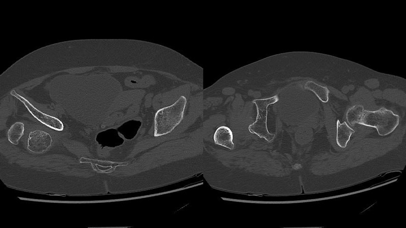 تدبير خلل التنسج الوركي الشديد DDH لدى سيدة بعمر متوسط Management of a hip dysplasia in a middle-aged woman 3 image 83