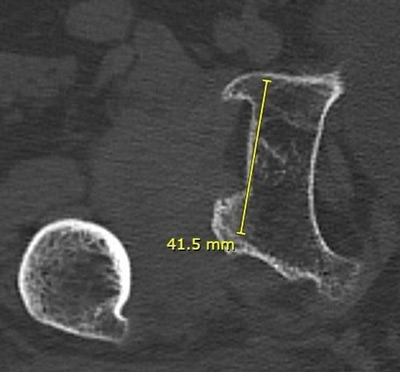 تدبير خلل التنسج الوركي الشديد DDH لدى سيدة بعمر متوسط Management of a hip dysplasia in a middle-aged woman 5 image 85