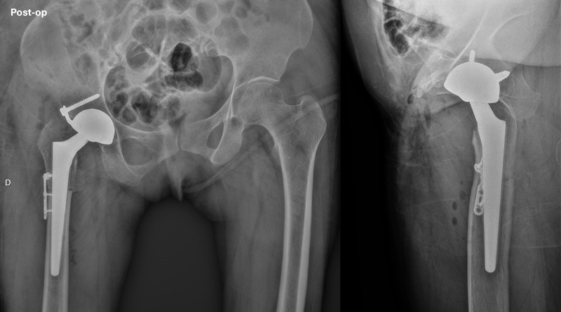 تدبير خلل التنسج الوركي الشديد DDH لدى سيدة بعمر متوسط Management of a hip dysplasia in a middle-aged woman 7 image 87