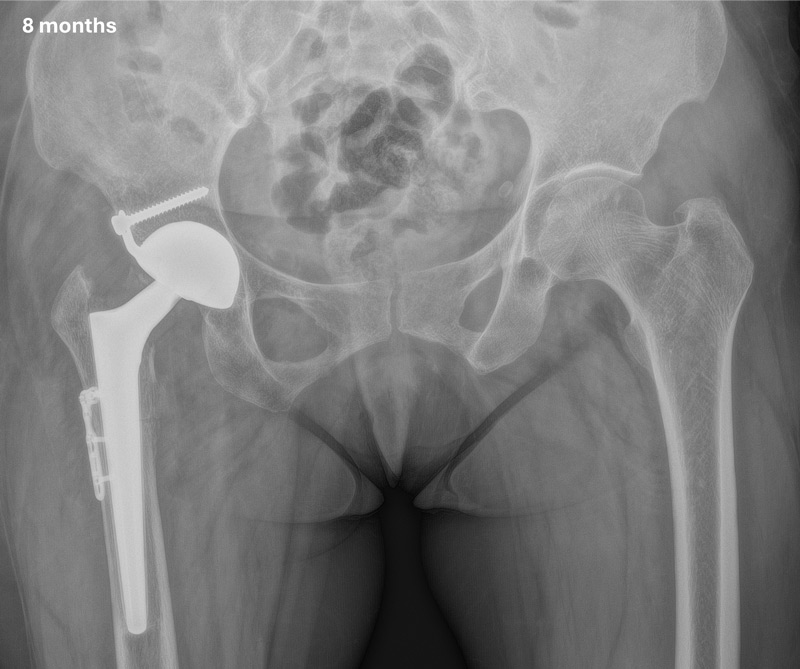 تدبير خلل التنسج الوركي الشديد DDH لدى سيدة بعمر متوسط Management of a hip dysplasia in a middle-aged woman 9 image 89