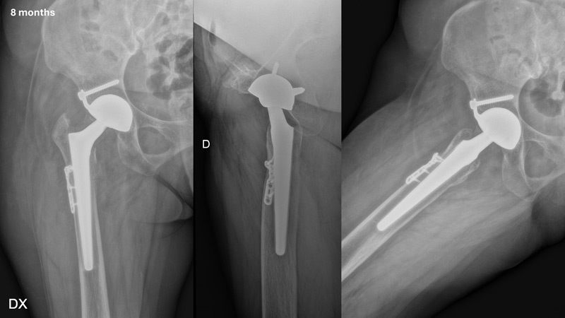تدبير خلل التنسج الوركي الشديد DDH لدى سيدة بعمر متوسط Management of a hip dysplasia in a middle-aged woman 10 image 90