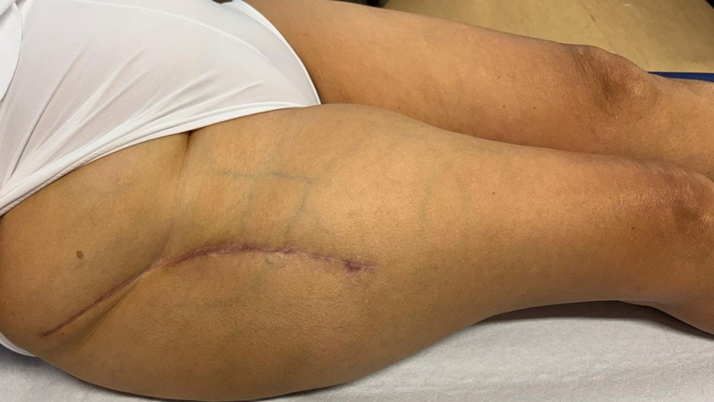 تدبير خلل التنسج الوركي الشديد DDH لدى سيدة بعمر متوسط Management of a hip dysplasia in a middle-aged woman 11 image 91