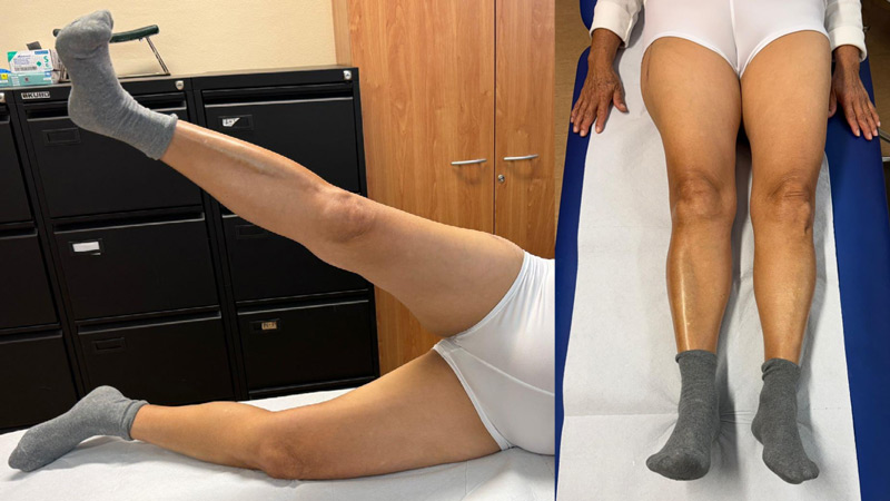 تدبير خلل التنسج الوركي الشديد DDH لدى سيدة بعمر متوسط Management of a hip dysplasia in a middle-aged woman 13 image 93