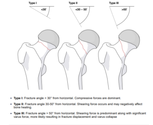 pauwel classification