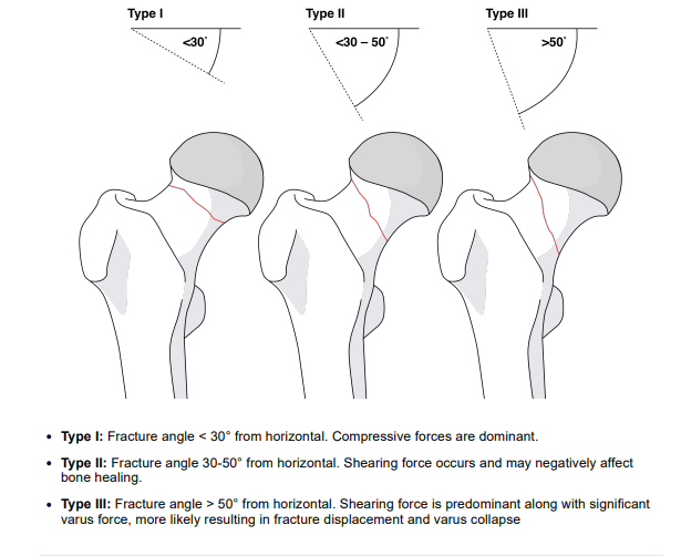 Pauwels Classification