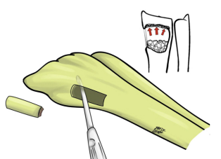جراحات الإنقاذ في داء كينبوك: مراجعة سريرية منهجية وفق منهجية الطب المسند بالبرهان (EBM) مستوحاة من مجموعة دراسات سريرية حول علاج داء كينبوك 1 image 54