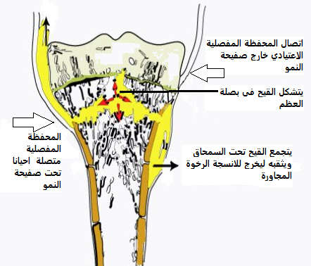 التهاب العظم والنقي الحاد عند الأطفال (Acute Hematogenous Osteomyelitis) 2 اصابة بصلات العظم بانتان العظم الحاد