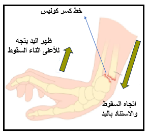 الية السقوط في حدوث كسر كوليس