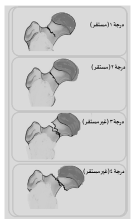 كسور عنق الفخذ عند كبار السن: الدليل الشامل للإصابة الأكثر حرجاً وطرق علاجها السريعة 3 تشخيص كسور عنق الفخذ عند كبار السن تصنيف غاردن