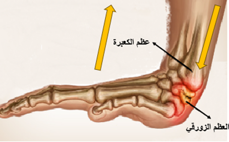 كسر العظم الزورقي -الية حدوث الكسر