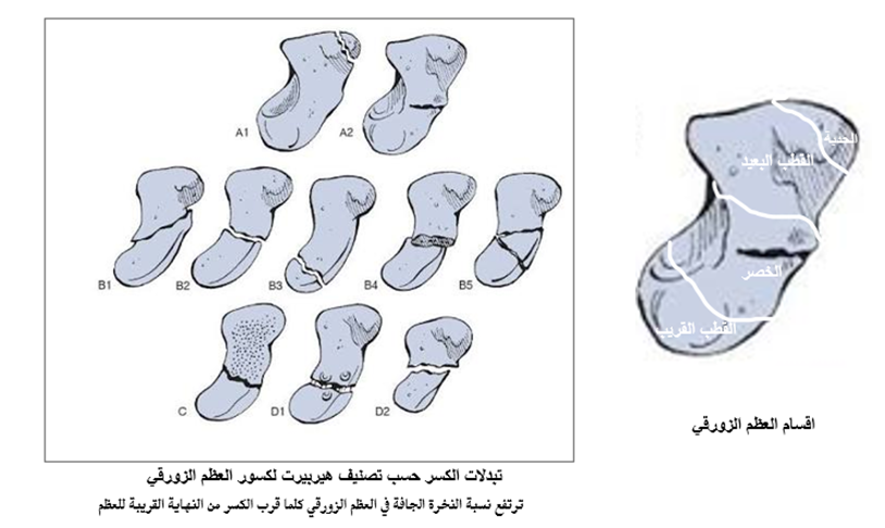 كسر العظم الزورقي تصنيف وانواع الكسر