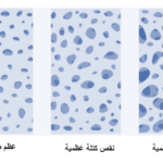 هشاشة العظام