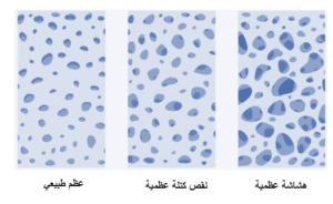 هشاشة العظام