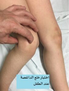 اختبار خلع الداغصة عند الطفل e1783344910979