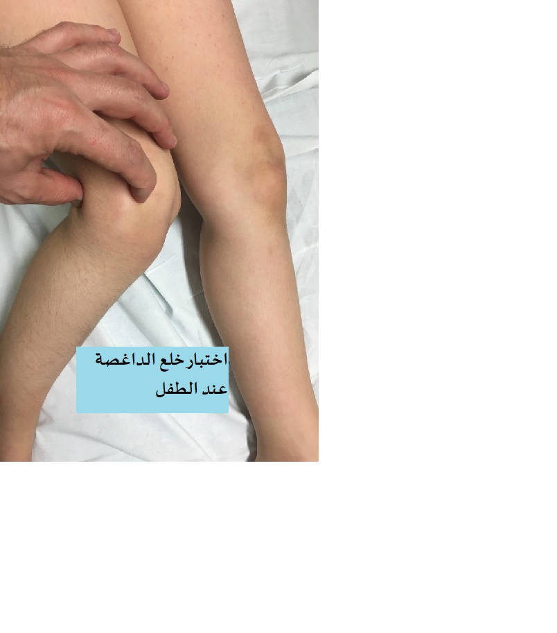 خلع الداغصة المتكرر عند الاطفال (صابونة الركبة) (Recurrent Patellar Dislocation in Children) 3 اختبار خلع الداغصة من قبل الفاحص