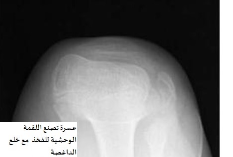 خلع الداغصة المتكرر عند الاطفال (صابونة الركبة) (Recurrent Patellar Dislocation in Children) 2 عسرة تصنع اللقمة الوحشية للفخذ مع خلع الداغصة