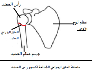 كسور أعلى عظم العضد (الكتف) عند كبار السن: الدليل الشامل للفهم، العلاج، والتعافي 2 كسور أعلى عظم العضد عند كبار السن كسور الكتف