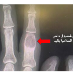 الورم الغضروفي الداخلي (Enchondroma): هل هو مدعاة للقلق؟ 8 image 34