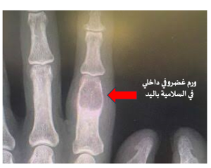 الورم الغضروفي الداخلي (Enchondroma): هل هو مدعاة للقلق؟ 17 image 34