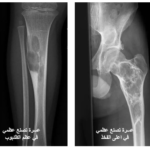 خلل التنسج الليفي (Fibrous Dysplasia): فهم الاضطراب وطرق العلاج 7 image 37