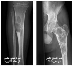 خلل التنسج الليفي (Fibrous Dysplasia): فهم الاضطراب وطرق العلاج 11 image 37