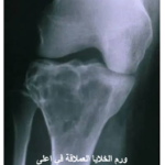 ورم الخلايا العملاقة في العظم (GCT): الطبيعة، المخاطر، وخيارات العلاج 6 image 38