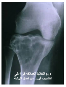ورم الخلايا العملاقة في العظم (GCT): الطبيعة، المخاطر، وخيارات العلاج 16 image 38