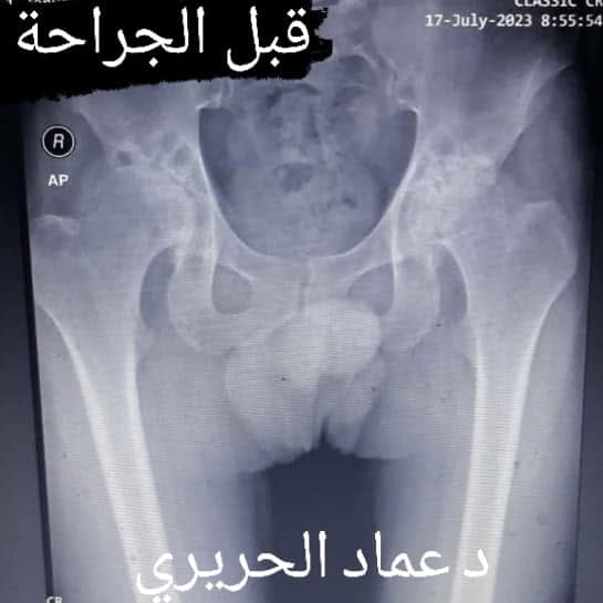 خشونة مفصل ورك مزدوج