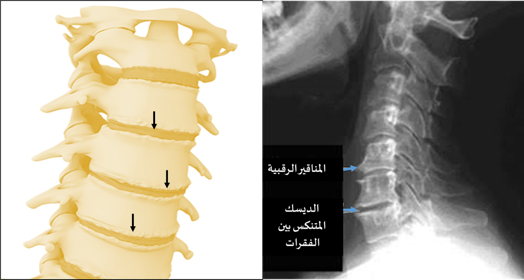 داء الفقرات الرقبية التنكسي-المناقير والانقراص