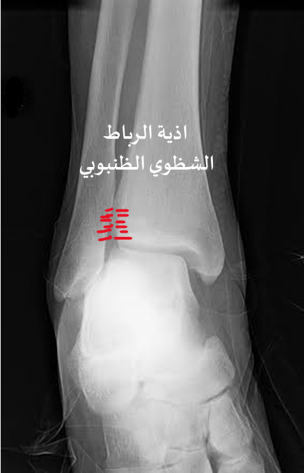 كسور الكاحل-اذية الارتفاق الشظوي الظنبوبي
