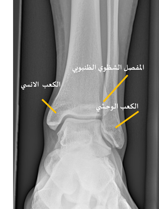 كسور الكاحل-مفصل عنق القدم