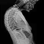 التهاب الفقار اللاصق (Ankylosing Spondylitis): الأسباب، التشخيص، واستراتيجيات إدارة الألم والحركة 9 انحناء العمود الفقري