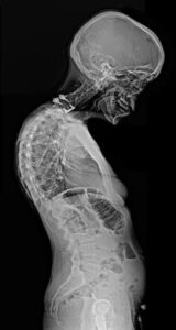 التهاب الفقار اللاصق (Ankylosing Spondylitis): الأسباب، التشخيص، واستراتيجيات إدارة الألم والحركة 10 انحناء العمود الفقري