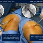 حقن بلازما في الورك
